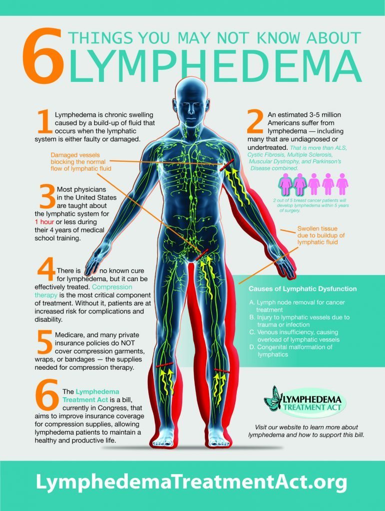 This infographic shares six things you may not know about lymphedema.