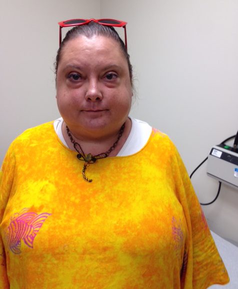 Linda Hidahl had gain 90 pounds before she received care for Cushing's disease.